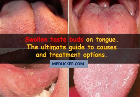 How to get rid of swollen taste buds?