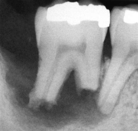 External Root Resorption – Teeth & Chiefs