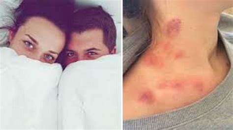 Awesome Ways To Rid Of Love Bites Naturally And Quikly. - YouTube