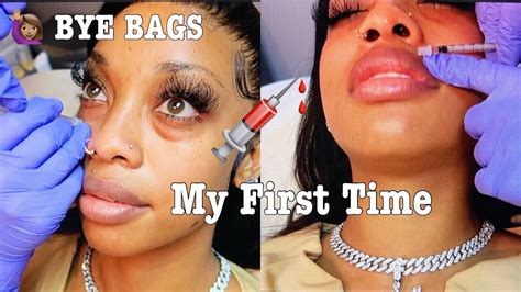 BLACK GIRL Gets FILLERS💉!!! I DIDN'T EXPECT THIS! - UNDER EYE + LIP ...