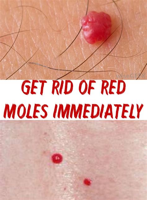 How To Remove Red Moles Naturally - HOWOTREMVO