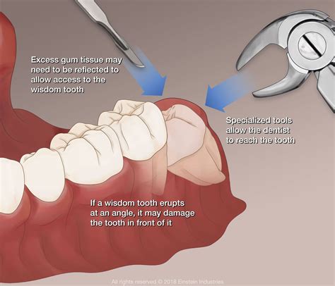 Wisdom Tooth Extraction Tools