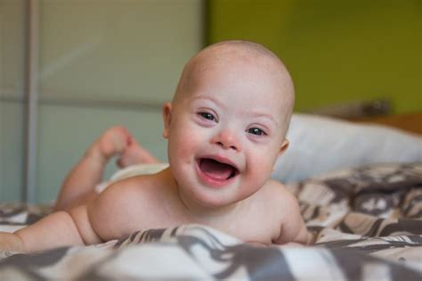 Survival outlook improving for babies with Down syndrome | Latest news for Doctors, Nurses and ...