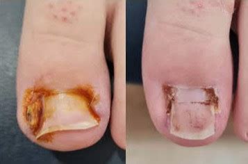 Ingrown Toenail 5 | Foot & Podiatry Surgery