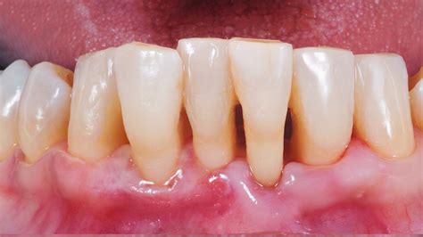 What Is Gum Recession and How to Treat It - Brisbane Smiles