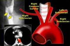 Aberrant right subclavian artery Vascular Ultrasound, Squamous, Sonography