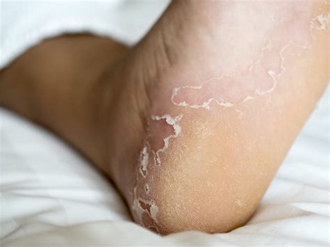 What Causes Itchy Feet? 4 Common Causes - JAWS podiatry