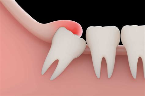 Wisdom Teeth Extraction - Extract The Pain And The Tooth. blog by flack flores