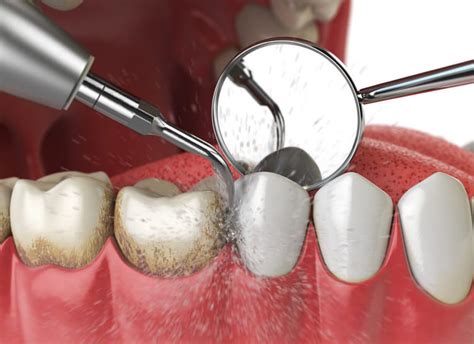 Scale and Clean at Keysborough Dental Surgery