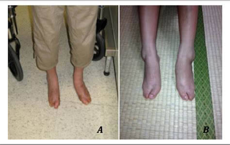 Figure 4 from Treatment of Cleft Foot Deformity With a Suture-Button ...