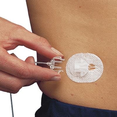 Infusion Sets | Medtronic