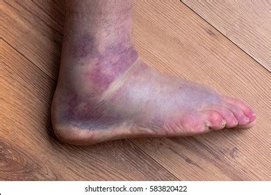 1,372 Ankle Bruise Images, Stock Photos & Vectors | Shutterstock