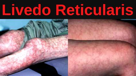 What is Livedo Reticularis? Causes, Treatment - YouTube