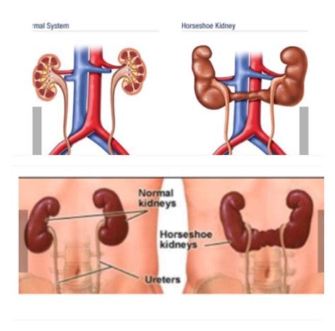 🙋🏻‍♀️ I have a Horseshoe Kidney 😳 yup looks just like it sounds. Also called Renal-Fusion. 👉🏼 It ...