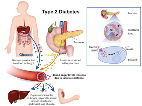 Timely insulin therapy to treat type 2 diabetes - Research Outreach