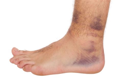 Sprained Ankle: 10 Symptoms of a Sprained Ankle