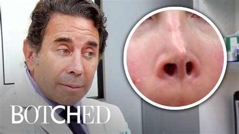 Botched Nose Job