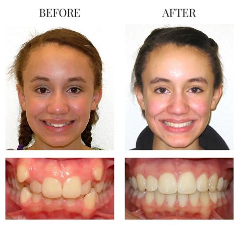 Palate Expander Before And After