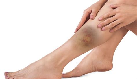 Calf Contusion - Symptoms, Causes, Treatment & Rehabiltiation