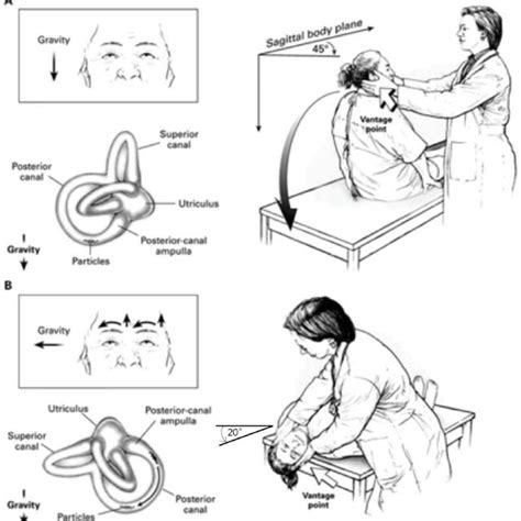 Gufoni maneuver for treatment of right-sided lateral semicircular canal... | Download Scientific ...