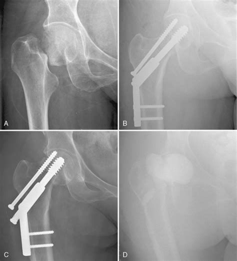 Femoral Neck Fracture Treatment