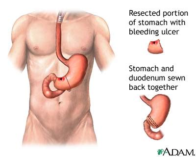 Gastrointestinal Bleeding - Wake Gastroenterology