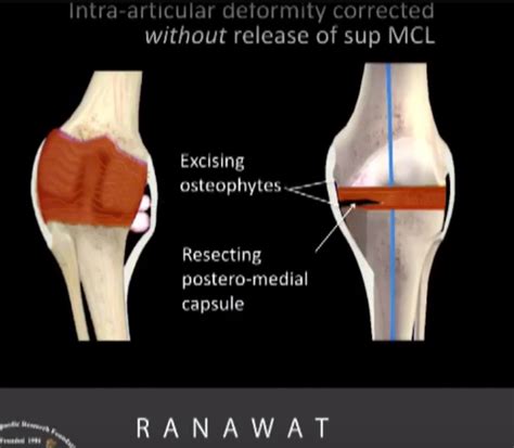 Tackling Varus Deformity in Total Knee Replacement — OrthopaedicPrinciples.com