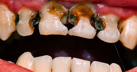 Oral Hygiene practices to prevent Toothaches (Tooth Decay) | Tooth decay, Cure tooth decay, Decay