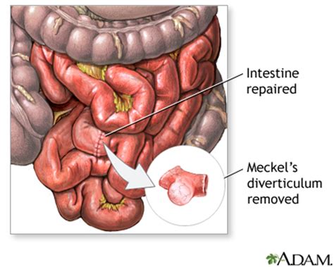 Meckel's diverticulectomy - series—Procedure: MedlinePlus Medical Encyclopedia