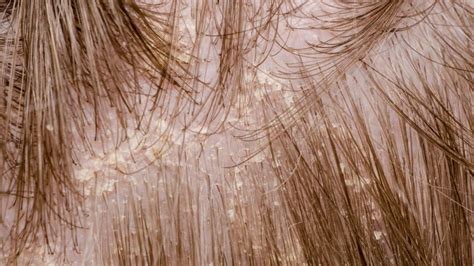 11 Causes Of Scalp Scabs How To Treat Them? – SkinKraft | atelier-yuwa.ciao.jp