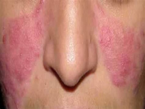 Dermatological Conditions