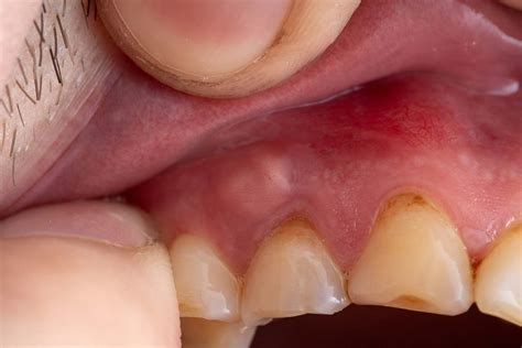 Abscessed Tooth in Corpus Christi | General Dentistry TX