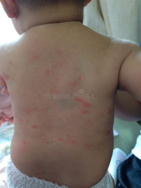 Hives in infant or baby editorial stock image. Image of immune - 50703049