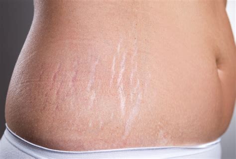 How to remove stretch marks after losing weight | by mike monney | Medium