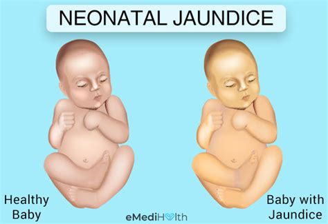 Glory Tips About How To Prevent Jaundice In Babies - Effectsteak33