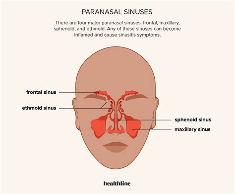 Sinus headache symptoms causes treatments – Artofit