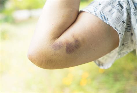 Possible Reasons and Risk Factors for Bruises - eMediHealth