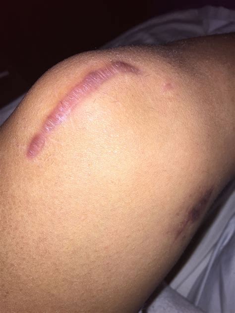 Wow it has been already 3 months post op! Scar it's no longer sensitive, but have not regain ...