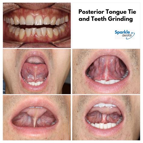 IMT of Maryland - A good case study of posterior tongue...