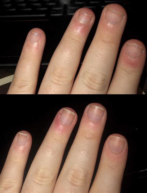 Two months worth of nail bed growth! Still working on not picking at the surrounding skin ...