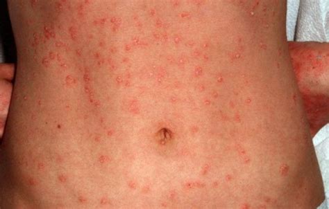 Guttate Psoriasis Skin Rash Photograph By Cnriscience - vrogue.co