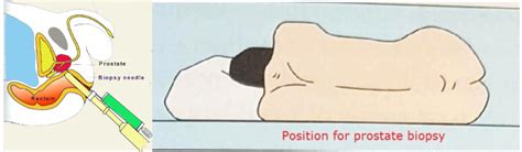 Prostate Biopsy (TRUS or MRI-US fusion Method) | Chin Chong Min Urology & Robotic Surgery Centre