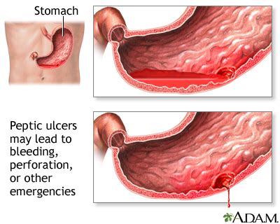 Bloody or tarry stools Information | Mount Sinai - New York