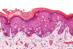 Paget's disease of the breast - Libre Pathology