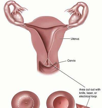 Conization – what is the procedure? How much does cervical conization cost? – Healthy Food Near Me