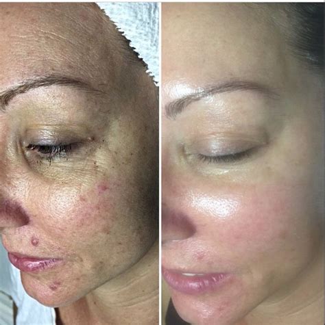 adapalene acne scars before after - Vanessa Anderson