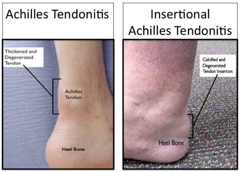 Will Heat Help Achilles Tendonitis at Ida Dimattia blog