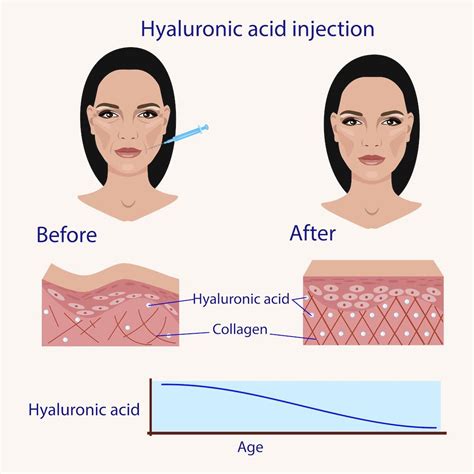 The Breakdown Of Hyaluronic Acid In Dermal Fillers And Facial Products