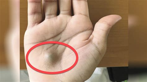 A Man Found This Strange Lump On His Palm Then A Scan Revealed The True Cause Of His Pain - YouTube