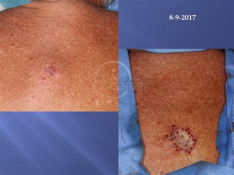 MELANOMA IN SITU OF BACK - Skin Cancer and Reconstructive Surgery Center